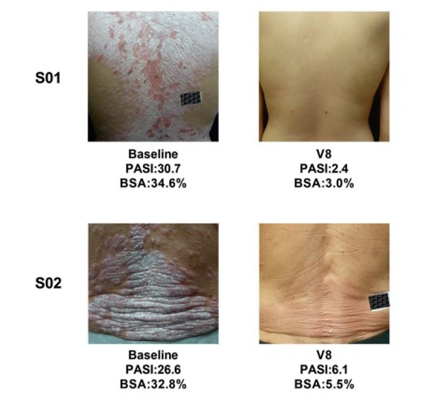 به ‌کارگیری سلول‌های بنیادی مزانشیمی بند ناف انسان به منظور درمان بیماری پسوریازیس